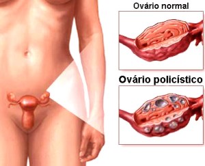 ovario-policistico